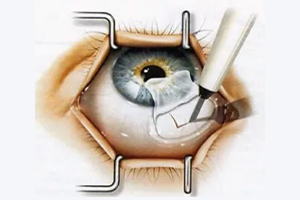 Glaukom Operation – Augenärztliche Gemeinschaftspraxis | Dr. Heuring, Dr. Jung & Kollegen