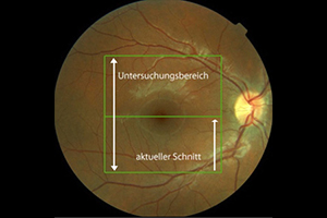 Optische Kohärenztomographie – Augenärztliche Gemeinschaftspraxis | Dr. Heuring, Dr. Jung & Kollegen