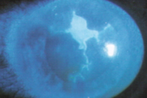 Hornhautentzündung – Augenärztliche Gemeinschaftspraxis | Dr. Heuring, Dr. Jung & Kollegen
