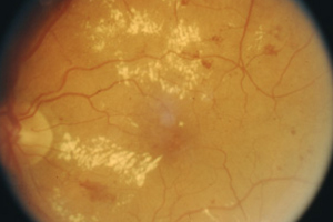 Nicht Proliferative Retinopathie – Augenärztliche Gemeinschaftspraxis | Dr. Heuring, Dr. Jung & Kollegen