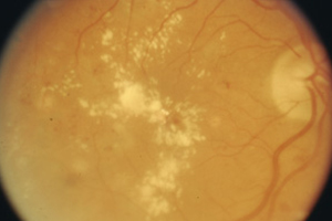 Proliferative Retinopathie – Augenärztliche Gemeinschaftspraxis | Dr. Heuring, Dr. Jung & Kollegen