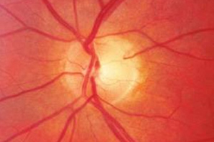 Photographie des Sehnervenkopfes – Augenärztliche Gemeinschaftspraxis | Dr. Heuring, Dr. Jung & Kollegen