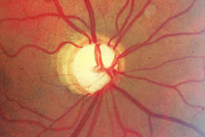Photographie des Sehnervenkopfes – Augenärztliche Gemeinschaftspraxis | Dr. Heuring, Dr. Jung & Kollegen